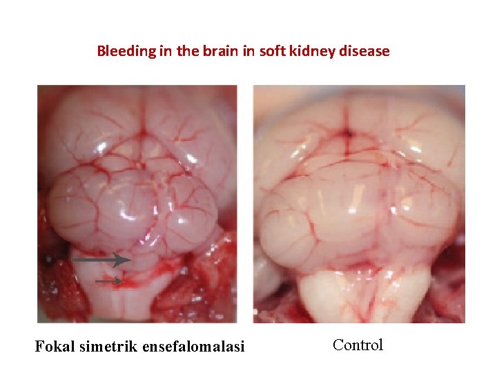 Bleeding in the brain in soft kidney disease Fokal simetrik ensefalomalasi Control 