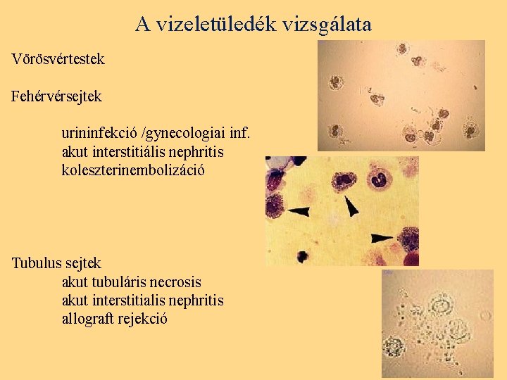 A vizeletüledék vizsgálata Vörösvértestek Fehérvérsejtek urininfekció /gynecologiai inf. akut interstitiális nephritis koleszterinembolizáció Tubulus sejtek