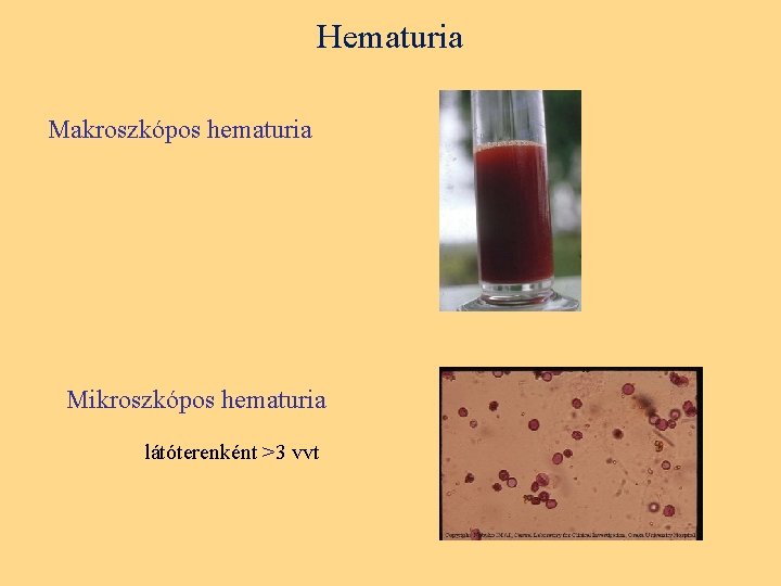 Hematuria Makroszkópos hematuria Mikroszkópos hematuria látóterenként >3 vvt 