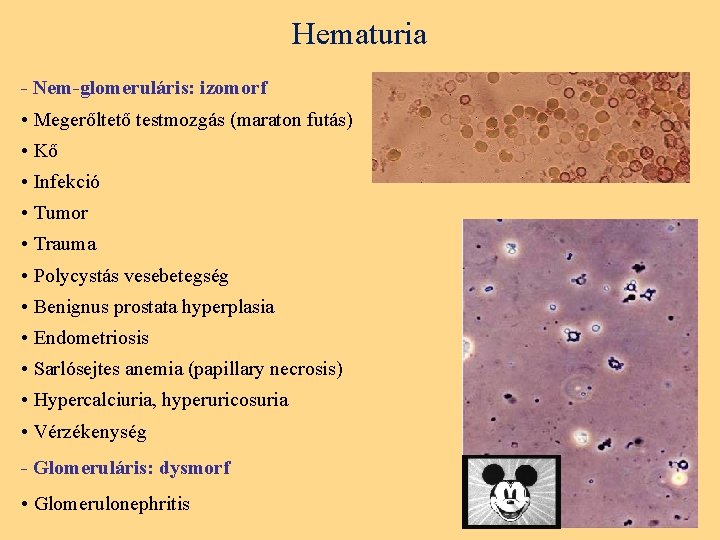 Hematuria - Nem-glomeruláris: izomorf • Megerőltető testmozgás (maraton futás) • Kő • Infekció •