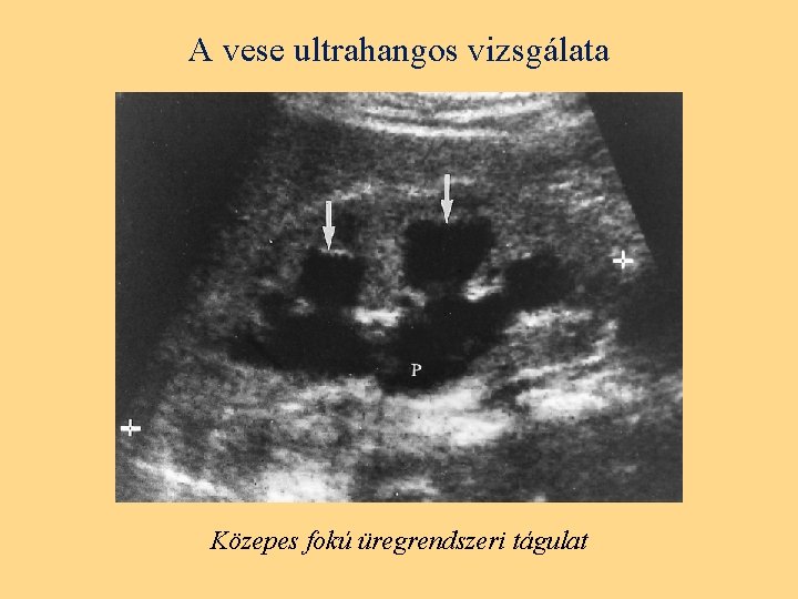 A vese ultrahangos vizsgálata Közepes fokú üregrendszeri tágulat 