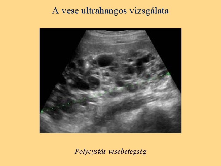 A vese ultrahangos vizsgálata Polycystás vesebetegség 