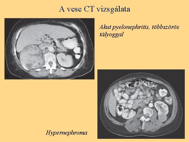 A vese CT vizsgálata Akut pyelonephritis, többszörös tályoggal Hypernephroma 