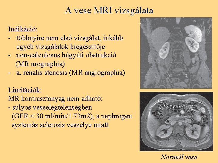 A vese MRI vizsgálata Indikáció: - többnyire nem első vizsgálat, inkább egyéb vizsgálatok kiegészítője