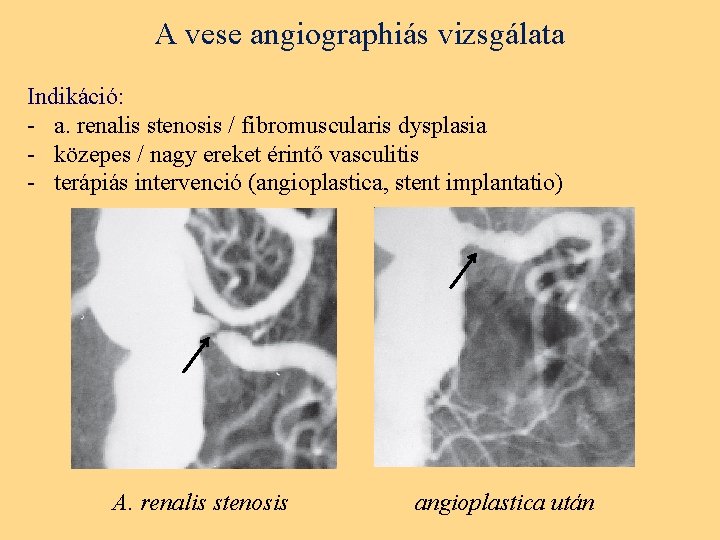 A vese angiographiás vizsgálata Indikáció: - a. renalis stenosis / fibromuscularis dysplasia - közepes