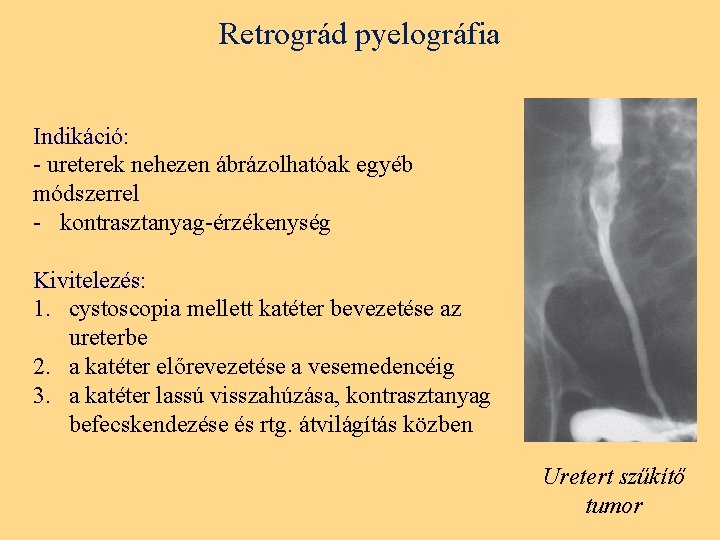 Retrográd pyelográfia Indikáció: - ureterek nehezen ábrázolhatóak egyéb módszerrel - kontrasztanyag-érzékenység Kivitelezés: 1. cystoscopia