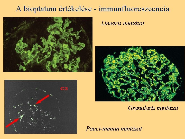 A bioptatum értékelése - immunfluoreszcencia Linearis mintázat Granularis mintázat Pauci-immun mintázat 