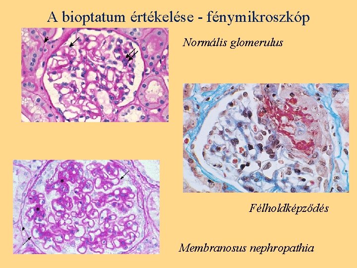 A bioptatum értékelése - fénymikroszkóp Normális glomerulus Félholdképződés Membranosus nephropathia 