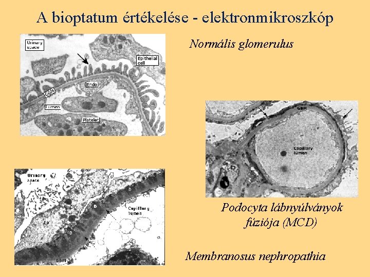A bioptatum értékelése - elektronmikroszkóp Normális glomerulus Podocyta lábnyúlványok fúziója (MCD) Membranosus nephropathia 