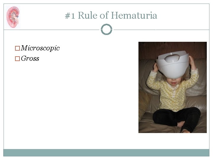 #1 Rule of Hematuria � Microscopic � Gross 