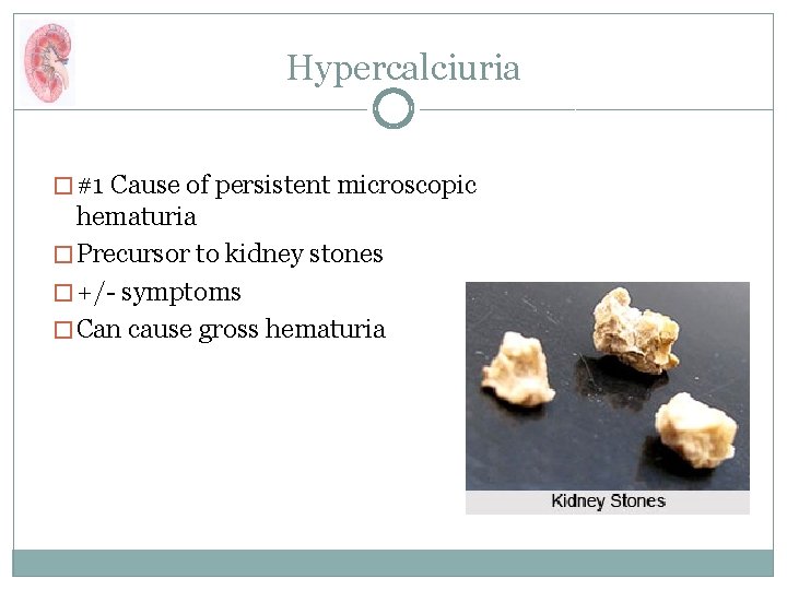Hypercalciuria � #1 Cause of persistent microscopic hematuria � Precursor to kidney stones �