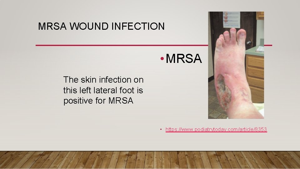 MRSA WOUND INFECTION • MRSA The skin infection on this left lateral foot is