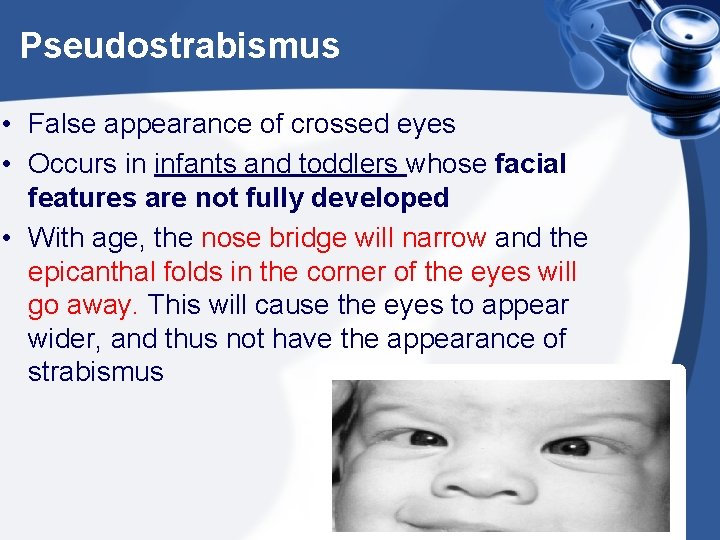 Pseudostrabismus • False appearance of crossed eyes • Occurs in infants and toddlers whose