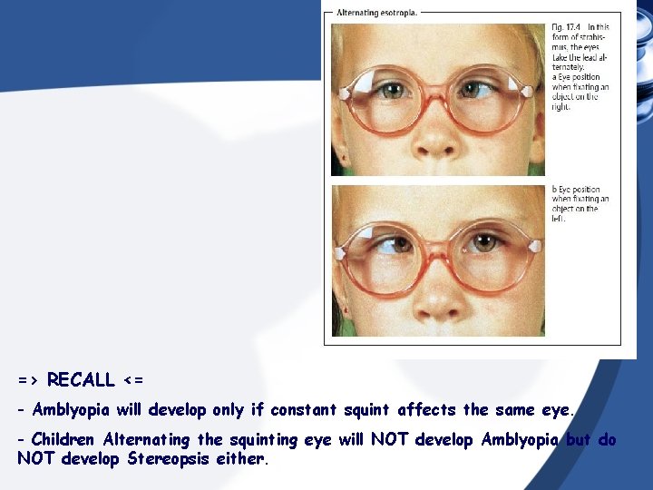 => RECALL <= - Amblyopia will develop only if constant squint affects the same