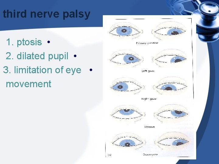 third nerve palsy 1. ptosis • 2. dilated pupil • 3. limitation of eye