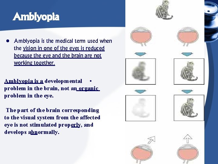 Amblyopia • Amblyopia is the medical term used when the vision in one of