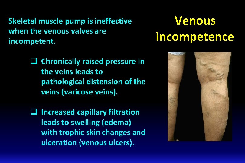 Skeletal muscle pump is ineffective when the venous valves are incompetent. q Chronically raised