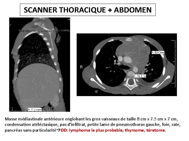 SCANNER THORACIQUE + ABDOMEN Masse médiastinale antérieure englobant les gros vaisseaux de taille 8