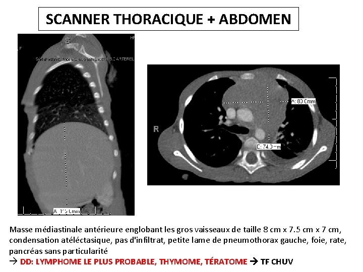 SCANNER THORACIQUE + ABDOMEN Masse médiastinale antérieure englobant les gros vaisseaux de taille 8