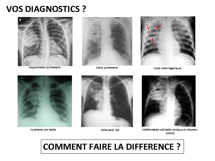 VOS DIAGNOSTICS ? Séquestration pulmonaire Syndrome carcinoïde Abcès pulmonaire Atélectasie LSD Kyste bronchogénique Malformation