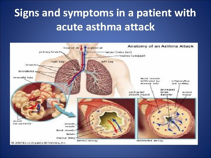 Signs and symptoms in a patient with acute asthma attack 