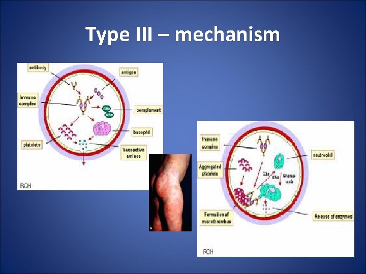 Type III – mechanism 