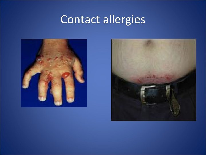 Contact allergies 