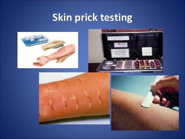 Skin prick testing 