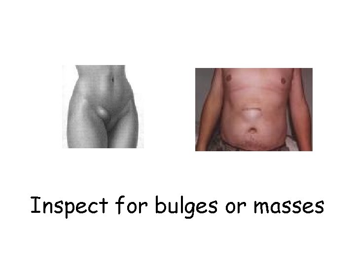 Inspect for bulges or masses 