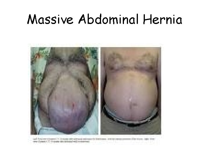 Massive Abdominal Hernia Massive Abdominal Hernia