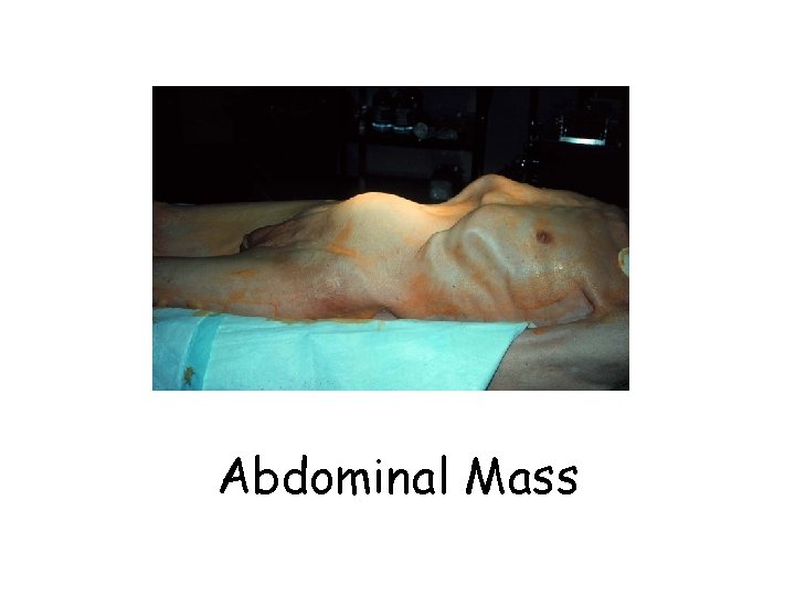 Abdominal Mass Abdominal Mass