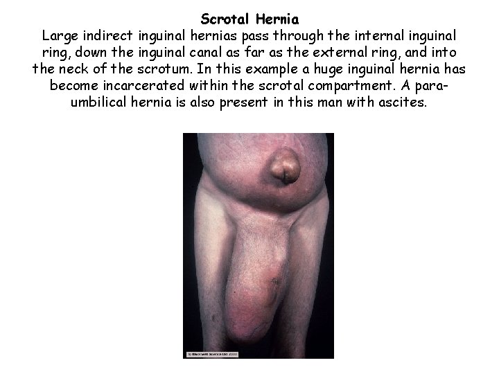 Scrotal Hernia Large indirect inguinal hernias pass through the internal inguinal ring, down the