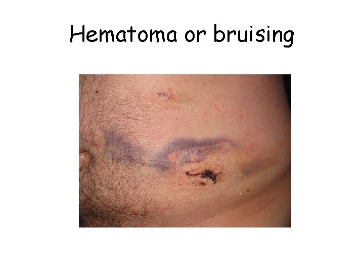 Hematoma or bruising 