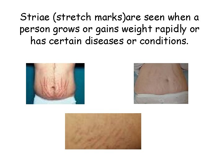 Striae (stretch marks)are seen when a person grows or gains weight rapidly or has