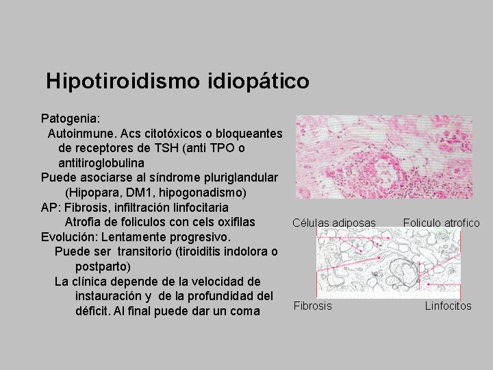 Hipotiroidismo idiopático Patogenia: Autoinmune. Acs citotóxicos o bloqueantes de receptores de TSH (anti TPO