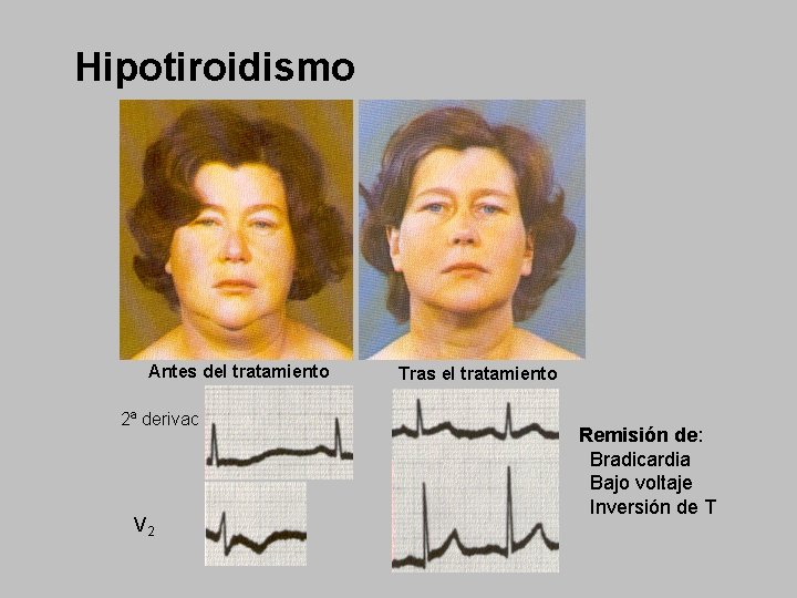 Hipotiroidismo Antes del tratamiento 2ª derivac V 2 Tras el tratamiento Remisión de: Bradicardia