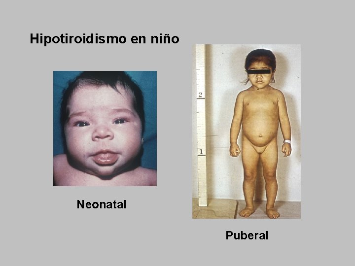Hipotiroidismo en niño Neonatal Puberal 
