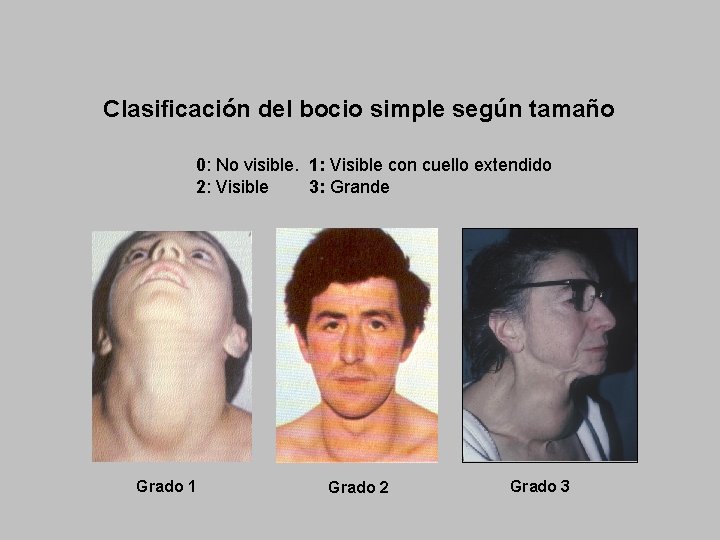 Clasificación del bocio simple según tamaño 0: No visible. 1: Visible con cuello extendido