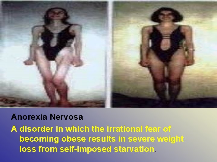 Anorexia Nervosa A disorder in which the irrational fear of becoming obese results in