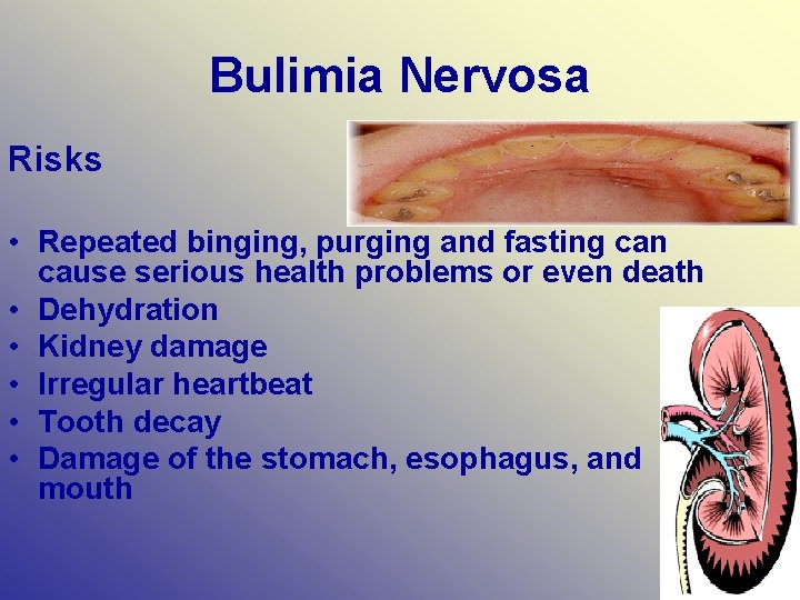 Bulimia Nervosa Risks • Repeated binging, purging and fasting can cause serious health problems
