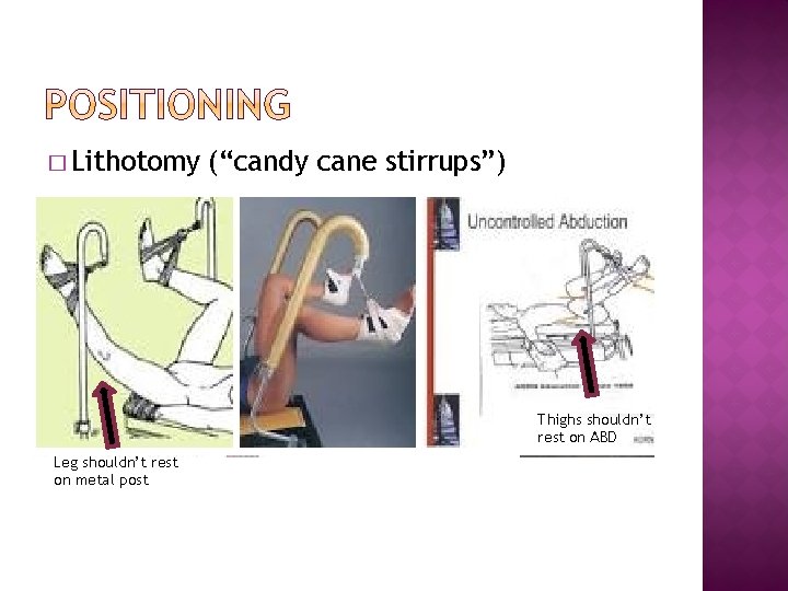 � Lithotomy (“candy cane stirrups”) Thighs shouldn’t rest on ABD Leg shouldn’t rest on