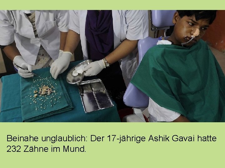Beinahe unglaublich: Der 17 -jährige Ashik Gavai hatte 232 Zähne im Mund. 