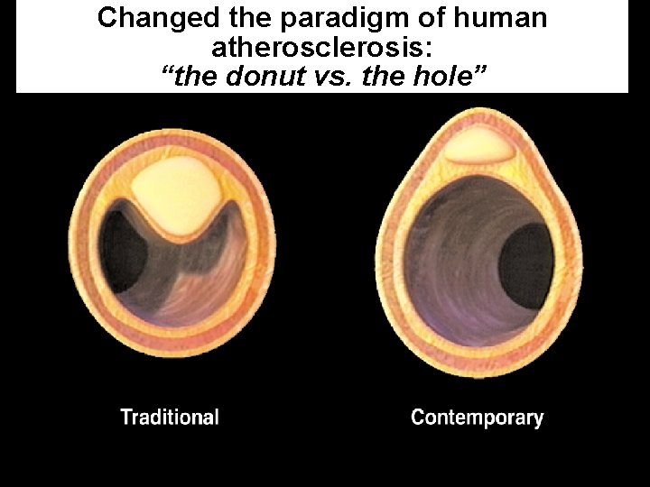 Changed the paradigm of human atherosclerosis: “the donut vs. the hole” 