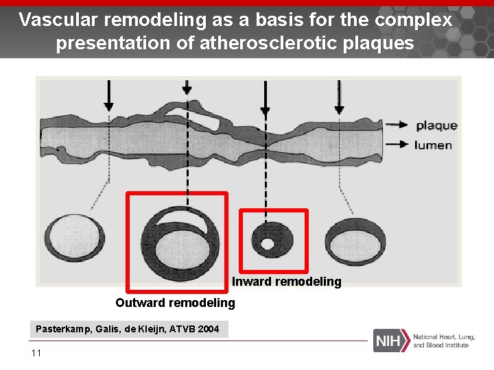 Vascular remodeling as a basis for the complex presentation of atherosclerotic plaques Inward remodeling