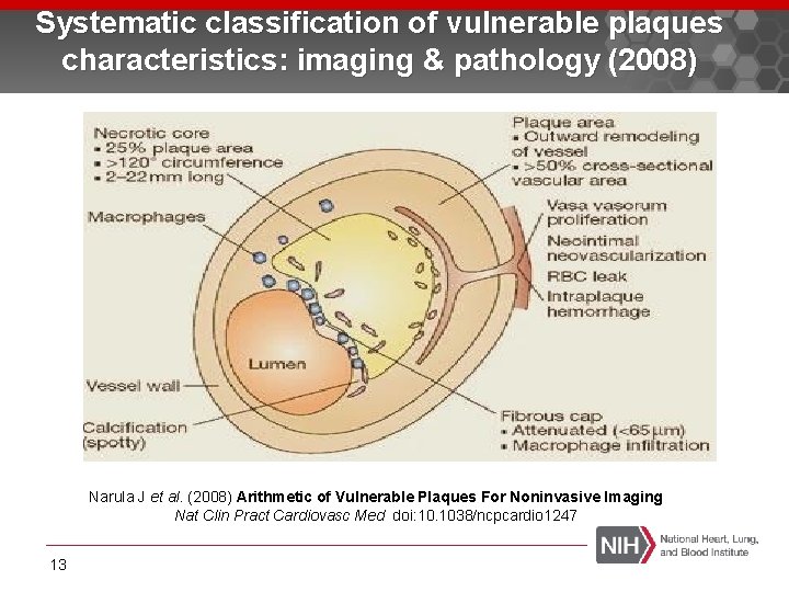 Systematic classification of vulnerable plaques characteristics: imaging & pathology (2008) Narula J et al.