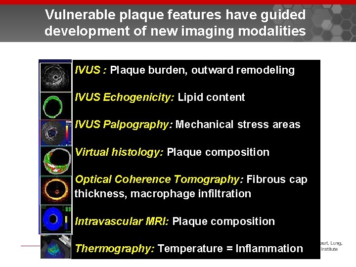 Vulnerable plaque features have guided development of new imaging modalities IVUS : Plaque burden,