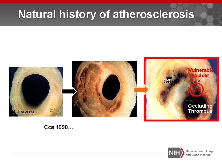 Natural history of atherosclerosis Lipid core Vulnerable shoulder Occluding Thrombus M. Davies Cca 1990…