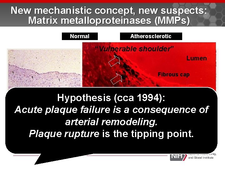 New mechanistic concept, new suspects: Matrix metalloproteinases (MMPs) Normal Atherosclerotic “Vulnerable shoulder” Lumen Fibrous