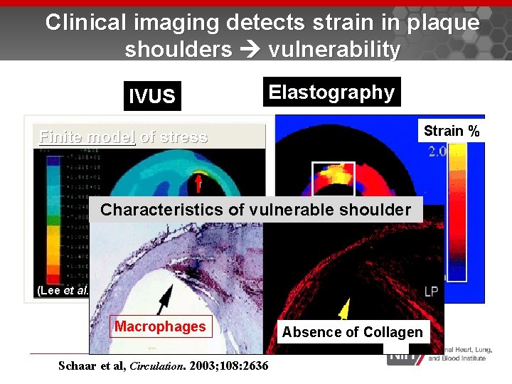 Clinical imaging detects strain in plaque shoulders vulnerability IVUS Elastography Strain % Finite model