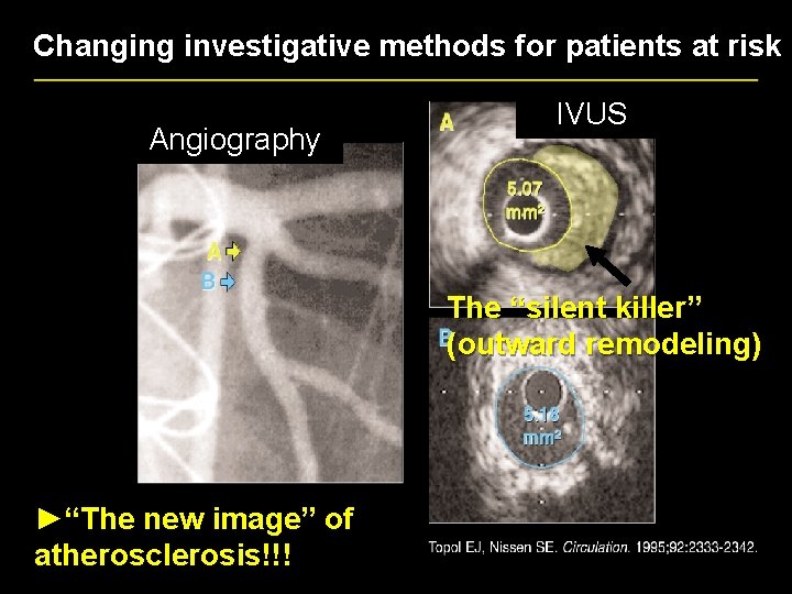 Changing investigative methods for patients at risk Angiography IVUS The “silent killer” (outward remodeling)